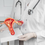 Mengenal Fibroid Rahim: Penyebab, Gejala, dan Penanganannya